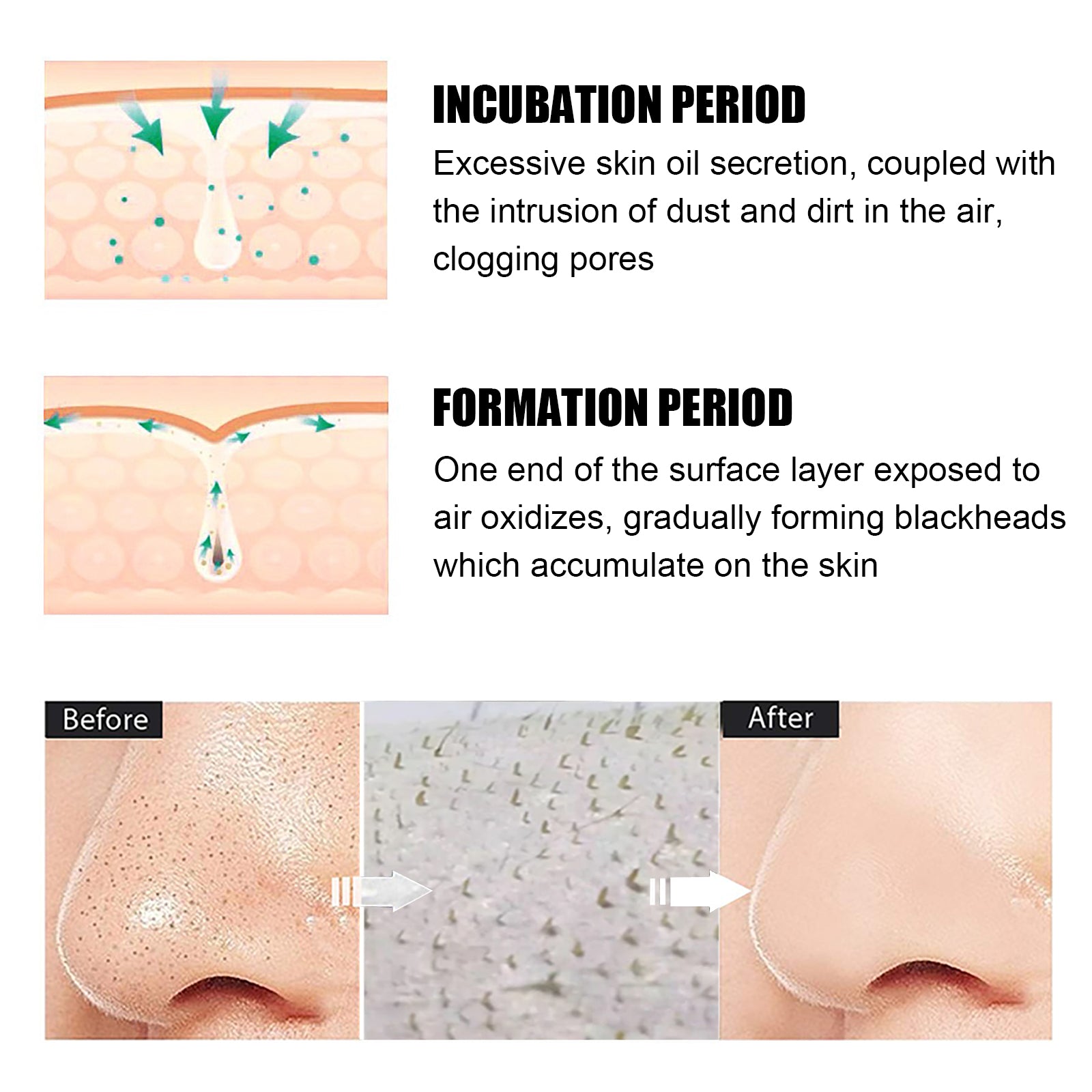 Blackhead Remover Tools -15g Blackhead Creamwith 40Pcs Blackhead Pore Strips