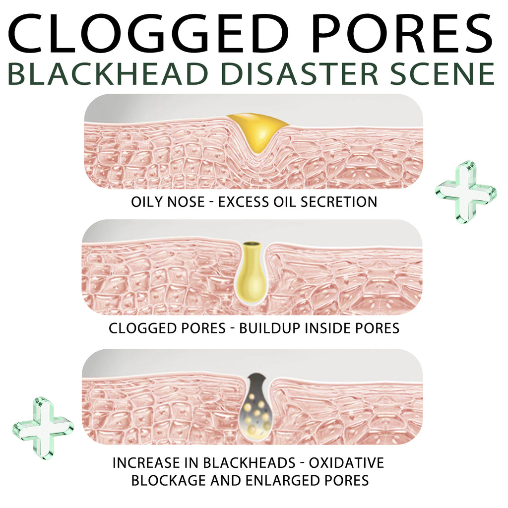 Blackhead Remover Tools -15g Blackhead Creamwith 40Pcs Blackhead Pore Strips